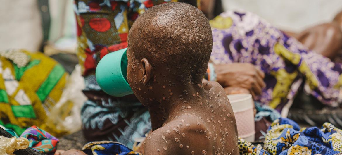 A child suffering from mpox at the mpox isolation unit of the UNICEF-supported Kavumu Hospital in South Kivu province, DR Congo. (July 2024)