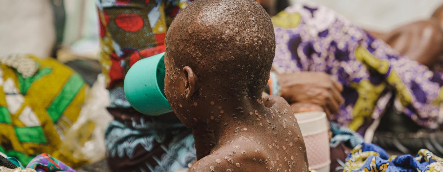 Un enfant souffrant de la variole dans l'unité d'isolement de la variole de l'hôpital Kavumu, soutenu par l'UNICEF, dans la province du Sud-Kivu, en République démocratique du Congo, le 23 juillet 2024.