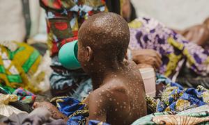 A child suffering from mpox at the mpox isolation unit of the UNICEF-supported Kavumu Hospital in South Kivu province, DR Congo. (July 2024)