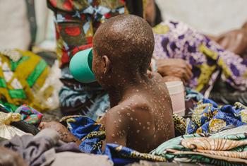 Un enfant souffrant de la variole dans l'unité d'isolement de la variole de l'hôpital Kavumu, soutenu par l'UNICEF, dans la province du Sud-Kivu, en République démocratique du Congo, le 23 juillet 2024.