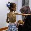 A severely malnourished girl in Gaza. Aid teams have repeatedly called for Israel to allow much more aid to enter Gaza to prevent the ongoing humanitarian catastrophe.