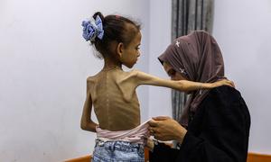 A severely malnourished girl in Gaza. Aid teams have repeatedly called for Israel to allow much more aid to enter Gaza to prevent the ongoing humanitarian catastrophe.