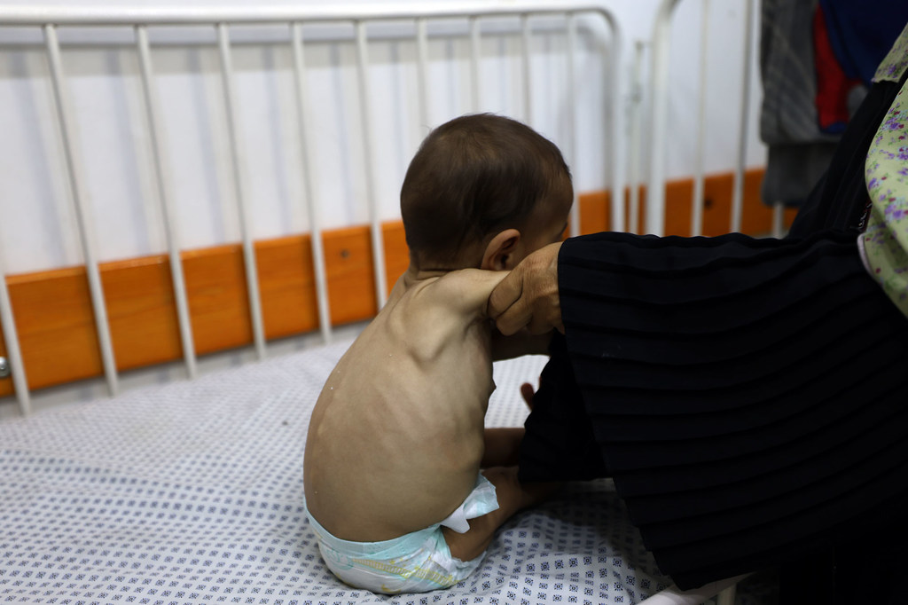 Un enfant souffrant de malnutrition sévère est soigné dans un hôpital de Gaza.