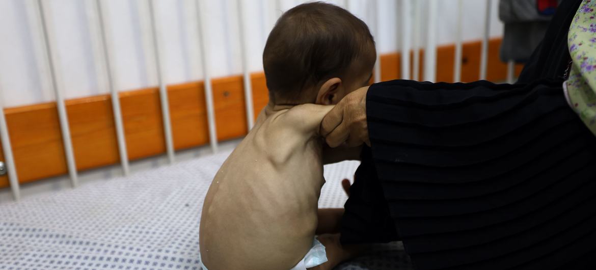 A severely malnourished child is treated in a hospital in Gaza. A severely malnourished child is treated in a hospital in Gaza.