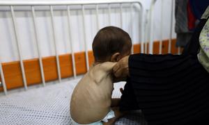 A severely malnourished child is treated in a hospital in Gaza.