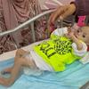 Un recién nacido recibe tratamiento por desnutrición en el hospital Nasser de Gaza.