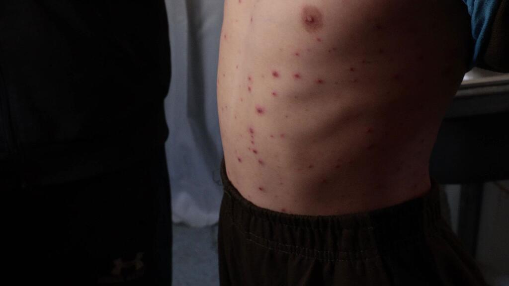 El torso de una persona muestra múltiples lesiones cutáneas rojas, compatibles con una enfermedad de la piel que se está propagando entre las personas desplazadas en Gaza.