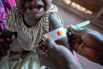 Uma criança de pele escura está sendo avaliada quanto à desnutrição em uma clínica de nutrição apoiada pela UNICEF em Juba, no Sudão do Sul. As mãos de um profissional de saúde são mostradas envolvendo uma fita MUAC (Circunferência do Braço Superior) colorida ao redor do braço da criança para avaliar seu estado nutricional.