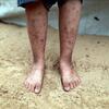 صورة قريبة لأرجل الطفل وقدميه العارية واقفة على الرمال، تظهر جروح الجلد الشديدة والجروح، مع خيمة مؤقتة في الخلفية.