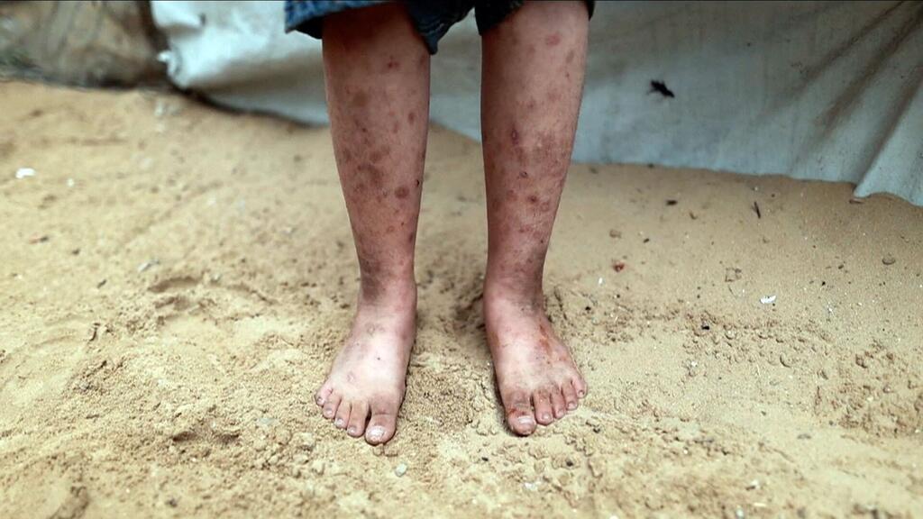 Un gros plan des jambes et des pieds nus d'un enfant debout sur le sable, montrant de graves plaies et lésions cutanées, avec une tente improvisée à l'arrière-plan.