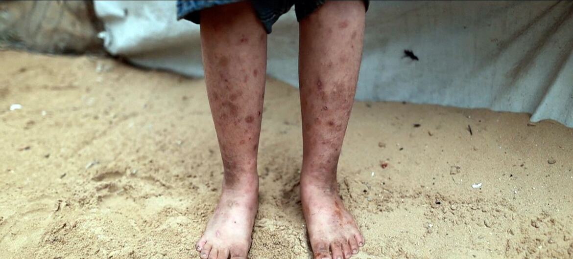 صورة قريبة لأرجل الطفل وقدميه العارية واقفة على الرمال، تظهر جروح الجلد الشديدة والجروح، مع خيمة مؤقتة في الخلفية.