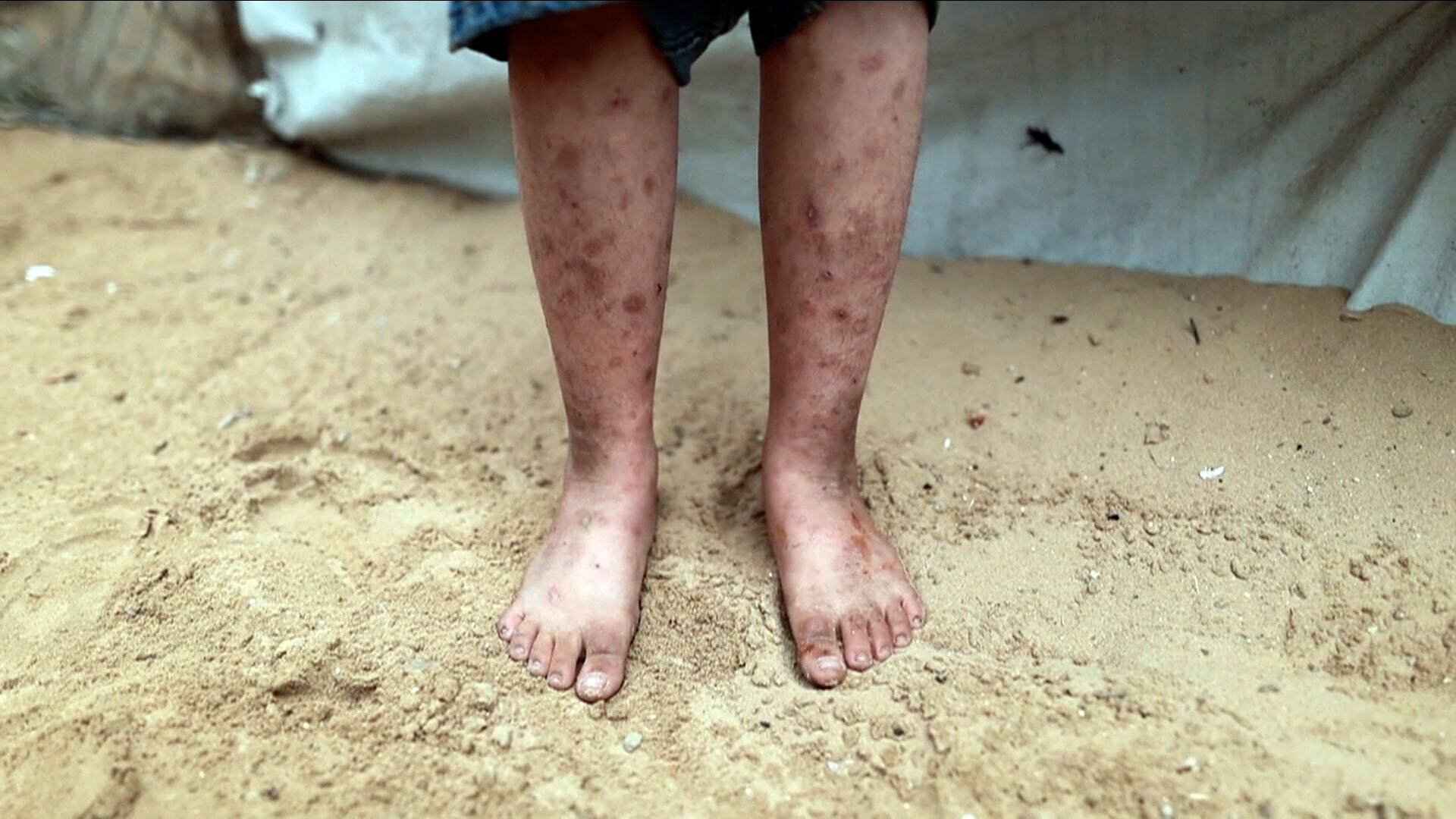 صورة قريبة لأرجل الطفل وقدميه العارية واقفة على الرمال، تظهر جروح الجلد الشديدة والجروح، مع خيمة مؤقتة في الخلفية.