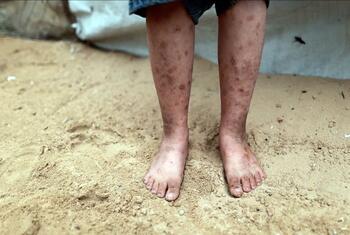 صورة قريبة لأرجل الطفل وقدميه العارية واقفة على الرمال، تظهر جروح الجلد الشديدة والجروح، مع خيمة مؤقتة في الخلفية.