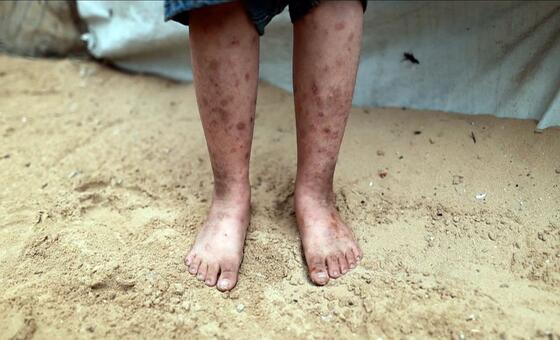 غزة - ارتفاع حالات الإصابة بالأمراض الجلدية في مواقع النزوح