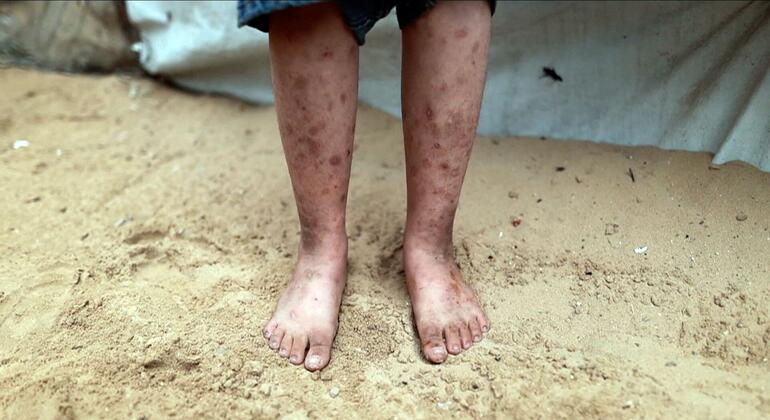صورة قريبة لأرجل الطفل وقدميه العارية واقفة على الرمال، تظهر جروح الجلد الشديدة والجروح، مع خيمة مؤقتة في الخلفية.