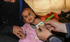 叙利亚北部的霍尔营地的一名婴儿接受营养不良筛查。