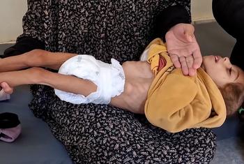 Misk Al-Madhoun, un niño gazatí que sufre hambre y desnutrición.