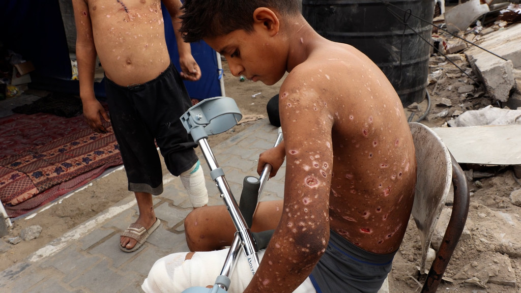 الطفل الفلسطيني زين الأنقر أصيب بجروح جراء انفجار جسم من مخلفات الحرب في غزة.