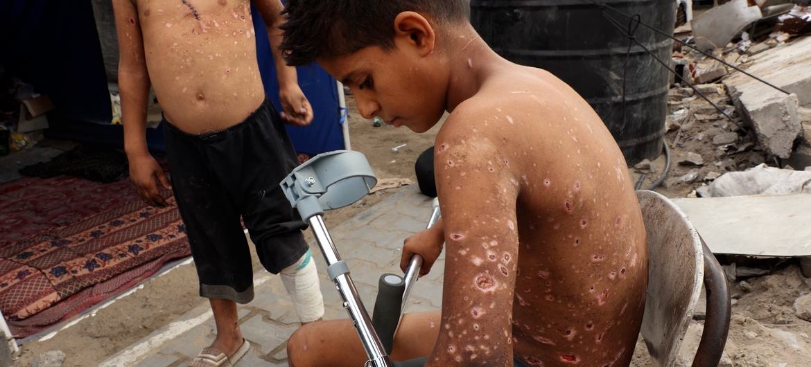 El niño palestino Zain Al-Anqar resultó herido por la explosión de un sospechoso resto de guerra en Gaza.