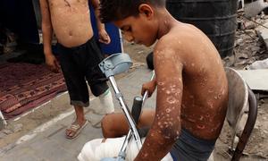 El niño palestino Zain Al-Anqar resultó herido por la explosión de un sospechoso resto de guerra en Gaza.