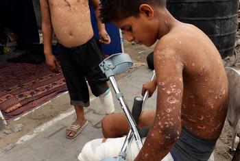 دھماکے کے نتیجے میں زین کا ننھا جسم چھروں کے زخموں سے بھرا ہوا ہے۔