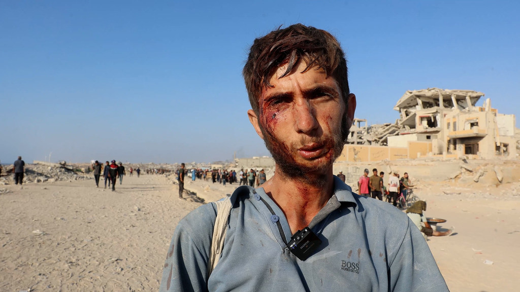 Un joven gazatí herido en la cara mientras intentaba obtenera ayuda humanitaria. Un joven gazatí herido en la cara mientras intentaba obtenera ayuda humanitaria.