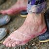 Primer plano de los pies de un migrante, cubiertos de graves ampollas y llagas de sangre, en Lajas Blancas, Panamá.