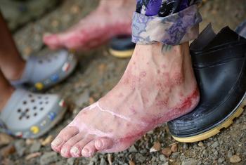 Un migrante llegó a Lajas Blancas, Panamá, con los pies llenos de sangre.