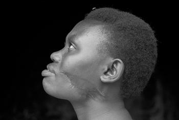 روانڈا میں 1994 میں ہوئی نسل کُشی میں بچ جانے والی سترہ سالہ یہ لڑکی اپنے چہرے پر لگے زخموں کے داغ دکھا رہی ہے۔