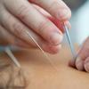 Uma mulher recebe tratamento de acupuntura