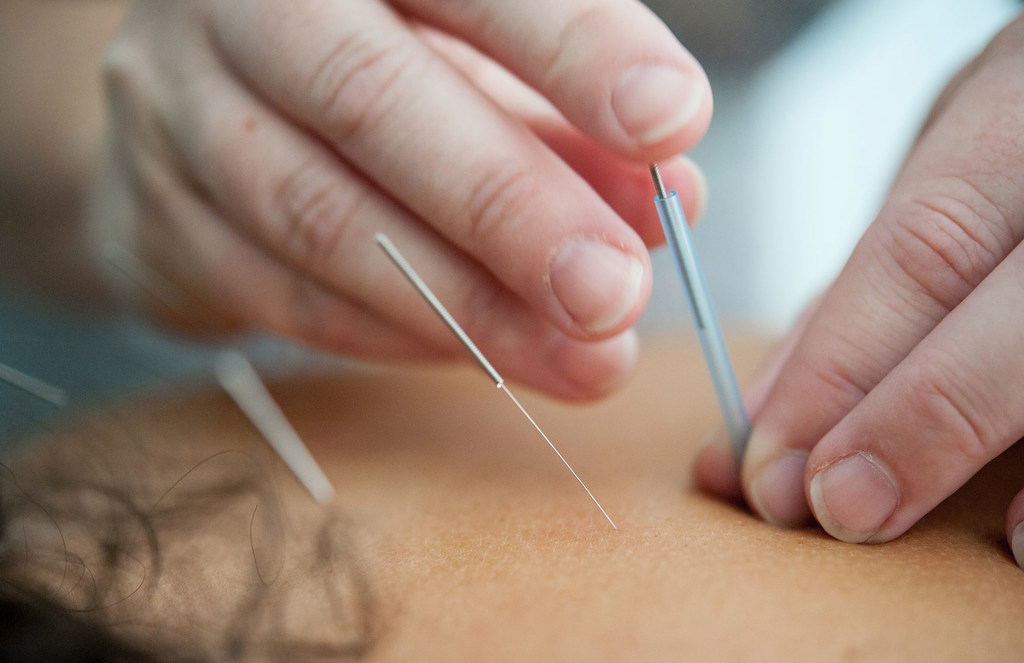Una mujer recibe tratamiento de acupuntura.