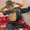Un niño recibe tratamiento por desnutrición en un hospital del sur de Gaza.