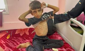 Un niño recibe tratamiento por desnutrición en un hospital del sur de Gaza.