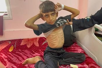 Un garçon est soigné pour malnutrition dans un hôpital du sud de Gaza.