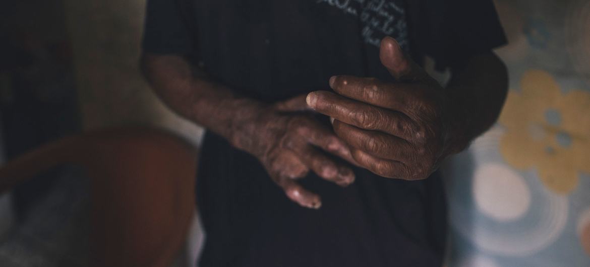 People affected by leprosy continue to suffer stigma and discrimination.