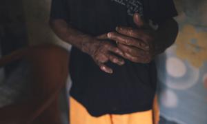 People affected by leprosy continue to suffer stigma and discrimination.