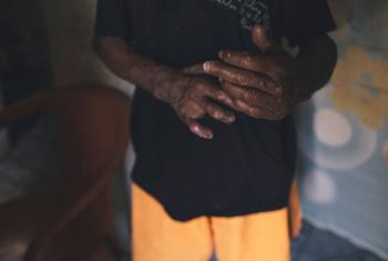 People affected by leprosy continue to suffer stigma and discrimination.