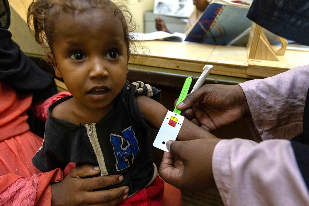 Tarehe 5 Aprili 2025, mtoto anachunguzwa utapiamlo katika hospitali ya Saudi huko Omdurman, Jimbo la Khartoum. ..Hospitali inapokea chanjo za kuokoa maisha, vifaa vya lishe na dawa muhimu kutoka UNICEF.