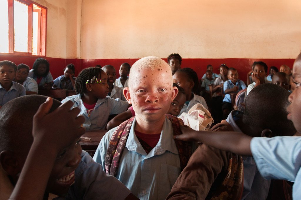 Um menino albino está sentado em uma sala de aula em Moçambique, cercado por seus colegas, enquanto eles ajustam sua mochila.