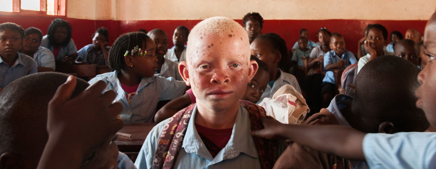 Lucas et son frère sont tous deux atteints d'albinisme, ce qui rend leur peau très sensible, leur vue faible et leur apparence un peu différente de celle de leurs frères et sœurs.