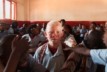 Lucas et son frère sont tous deux atteints d'albinisme, ce qui rend leur peau très sensible, leur vue faible et leur apparence un peu différente de celle de leurs frères et sœurs.