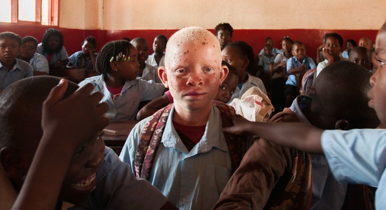 Lucas e seu irmão têm albinismo, o que torna sua pele muito sensível, sua visão ruim e sua aparência um pouco diferente de seus irmãos e irmãs.