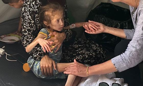 الأمم المتحدة: مصرع 100 طفل بسبب سوء التغذية والجوع في غزة