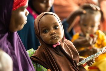 A child receives treatment for malnutrition at a UNICEF-supported centre in Dollow, Somalia.