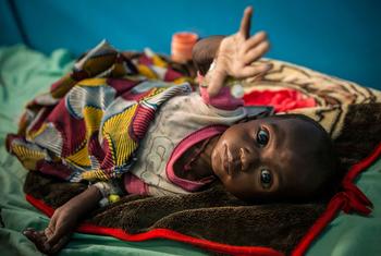一名7个月大的婴儿因严重急性营养不良在马里通布图的一家地区医院接受治疗。