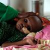 索马里布劳的一家诊所里，一名儿童正在从严重的营养不良中恢复。