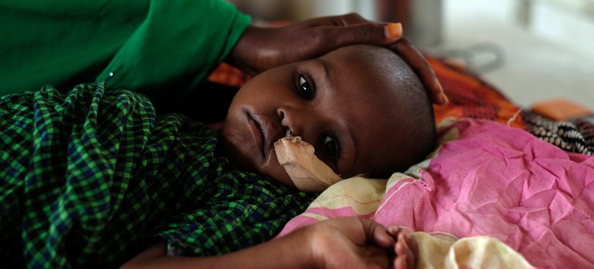 طفل يتعافى من سوء التغذية الحاد في عيادة في بوراو، الصومال.