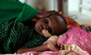 A child recovers from severe malnutrition at a clinic in Burao, Somalia.