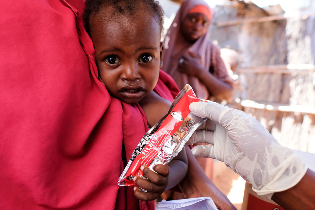 طفل يبلغ من العمر ثمانية عشر شهراً يعالج من سوء التغذية في مخيم للنازحين في الصومال.