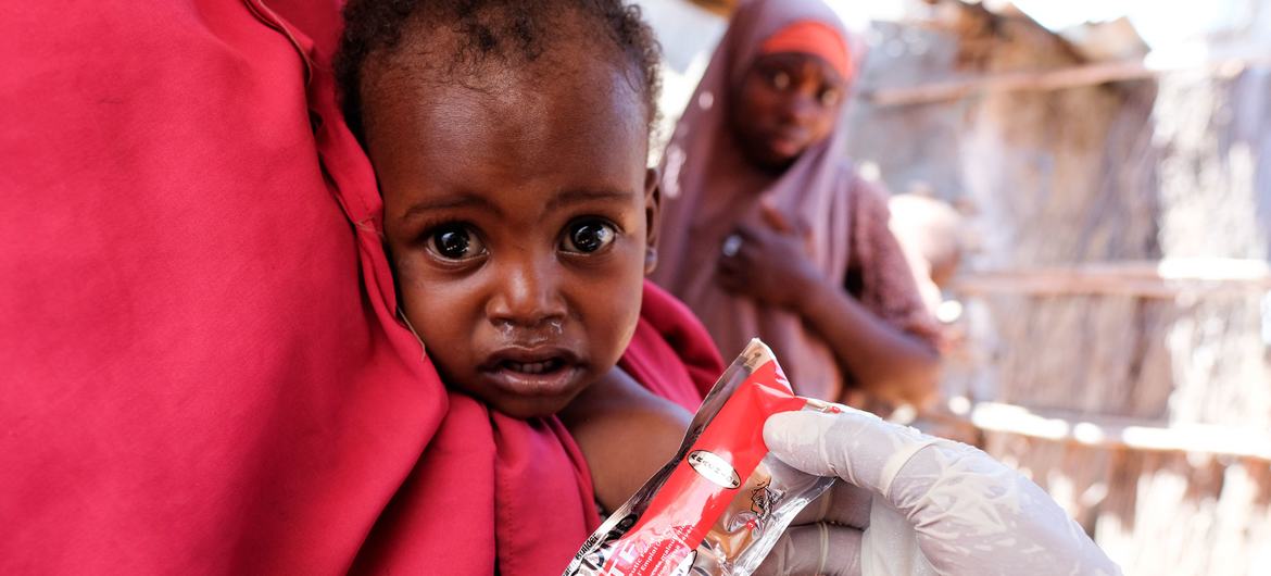Un garçon de dix-huit mois est soigné pour malnutrition dans un camp de personnes déplacées à Dalxiiska, en Somalie.
